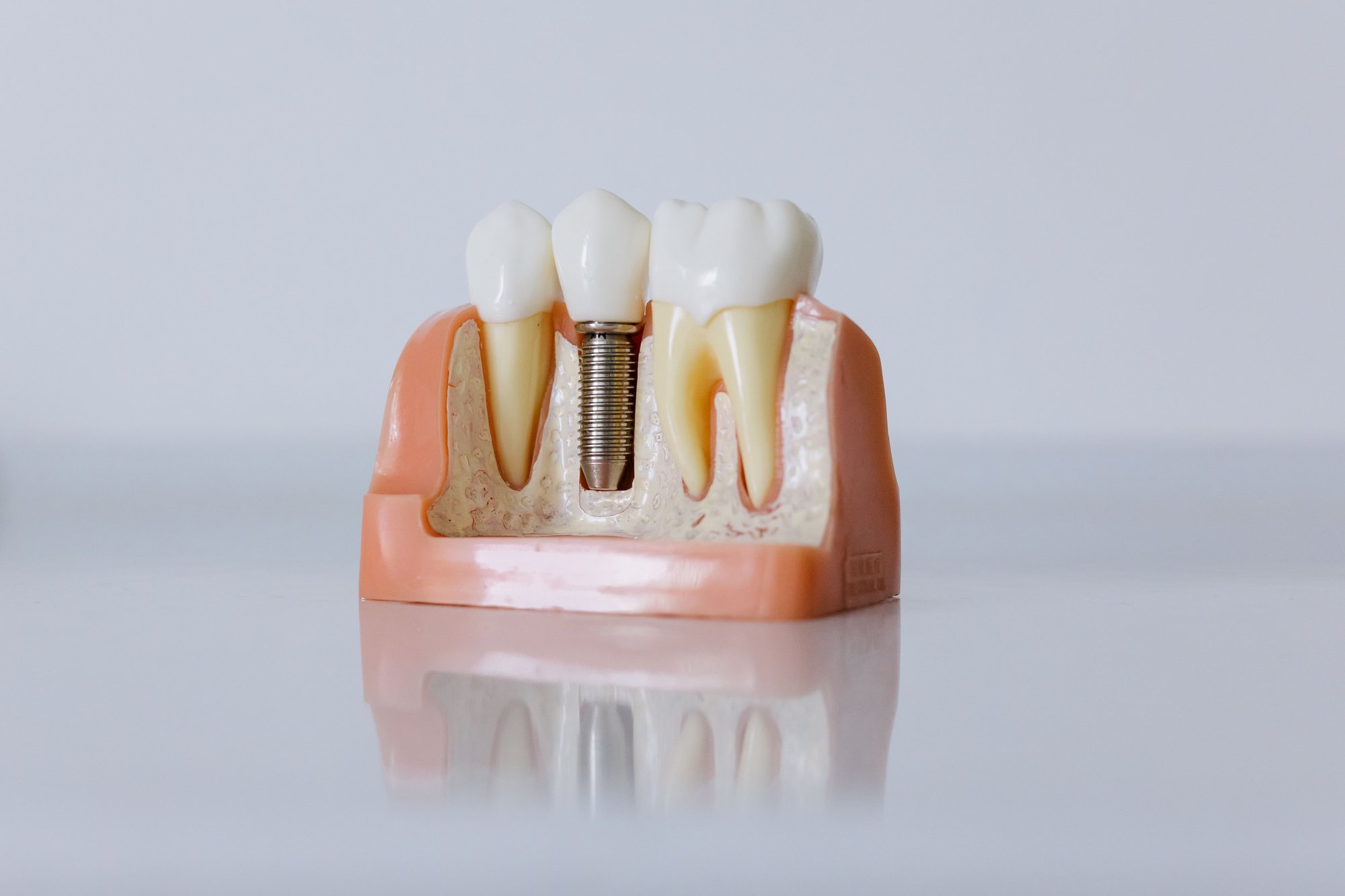 Implants-Image