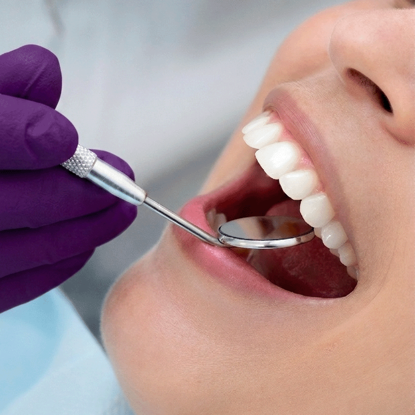 Composite Bonding - Image