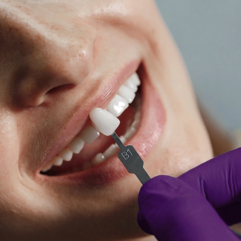 Veneers - Image